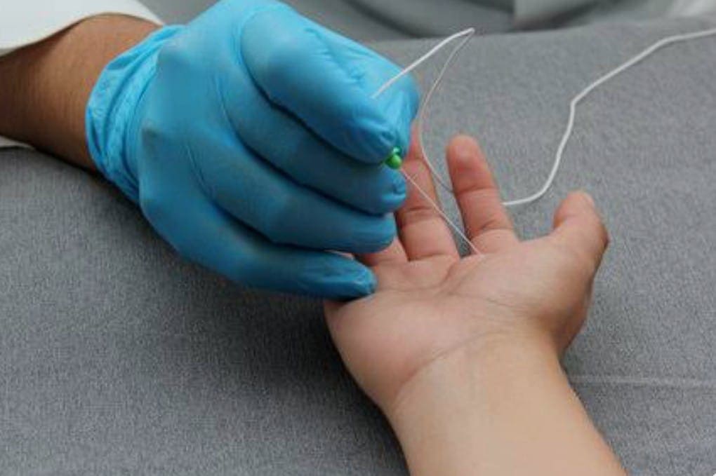 Electromiografía